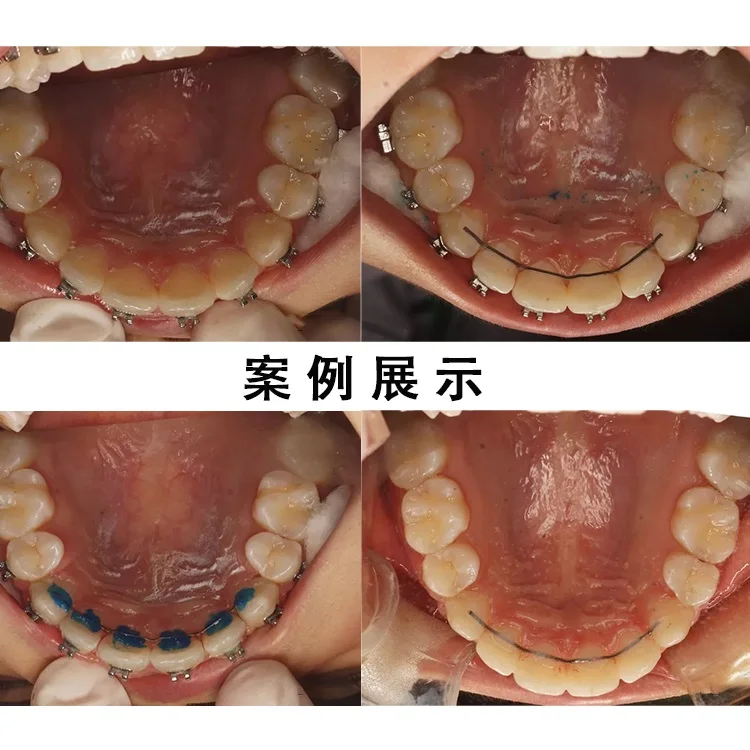 Diş Lingual ortodonti tutucu tel düz büküm teller paslanmaz çelik saf titanyum orto parantez parantez 1x153mm
