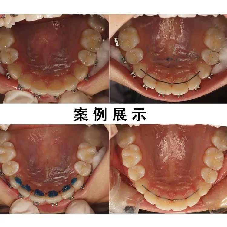 Diş Lingual ortodonti tutucu tel düz büküm teller paslanmaz çelik saf titanyum orto parantez parantez 1x153mm - Görsel 6
