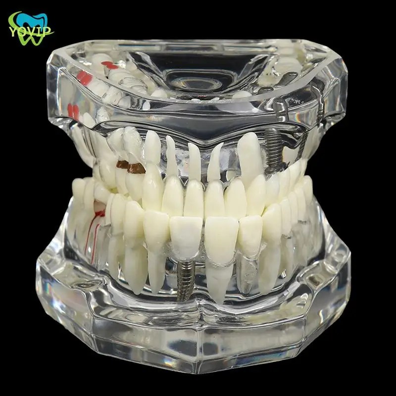 Tıp bilimi için diş hekimi restorasyon köprüsü diş hekimi diş hastalığı öğretimi çalışması diş implantı